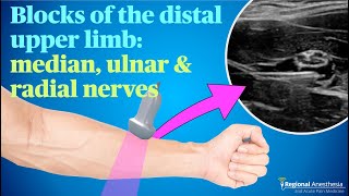 Ultrasound guided blocks of the median ulnar and radial nerves [upl. by Enihsnus831]