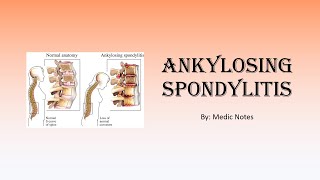 Ankylosing spondylitis  signs and symptoms Schober test Faber test imaging treatment [upl. by Edita]