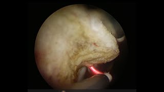 TURP transurethral resection of prostate Bipolar enucleation Lamidey NouryMedical [upl. by Doraj767]