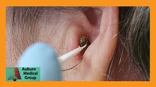 Chunky Earwax Removal  Auburn Medical Group [upl. by Maribelle]