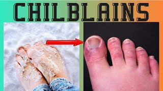 Chilblains causes symptoms treatment urduhindi [upl. by Hallagan]