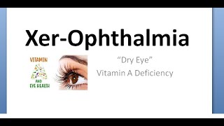 Ophthalmology 475 Xerophthalmia Vitamin A deficiency Eye Night blindness Ocular Classify Pediatrics [upl. by Letniuq23]