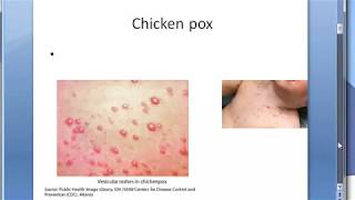 Microbiology 457 a Chicken pox VZV Varicella Zoster HHV3 Virus Difference Shingles [upl. by Onileba562]