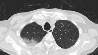 70 year old man with right massive pleural effusion camtasia2017 [upl. by Atener]