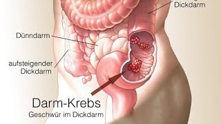 Darmkrebs Risikofaktoren Ursachen Diagnose und Therapie [upl. by Nemra]