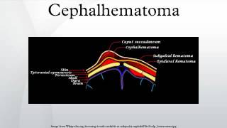 Cephalhematoma [upl. by Yeslah]