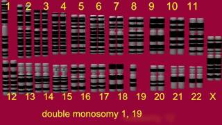 MONOSOMY DOUBLE MONOSOMY NULLISOMY [upl. by Drahsar]