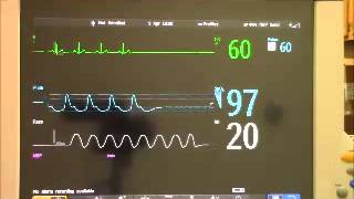 MP70 Asystole Alarm [upl. by Evin]