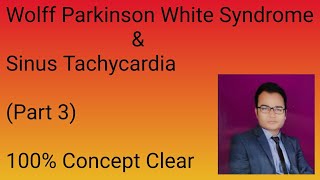 Wolff Parkinson white Syndrome Sinus Tachycardia [upl. by Ardeha528]