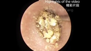 Easy earwax removal（简单的耳屎清理）20230822 [upl. by Ribal]