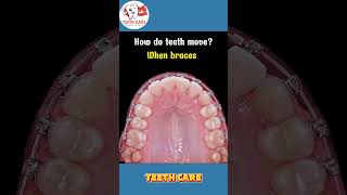 how do teeth move when braces teeth braces dental dentalcare dentalhealth dentalimplants [upl. by Olgnaed]