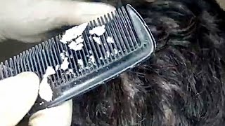 Dandruff Scratching My Husband Has Big Flakes  NO TALKING Pt5 [upl. by Gibson]