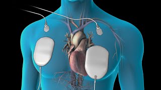 Cardioversion for Atrial Fibrillation [upl. by Cotterell]