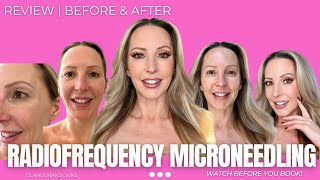 Radiofrequency Microneedling Review  Is It Worth It The What Why Before amp After [upl. by Haleemak]