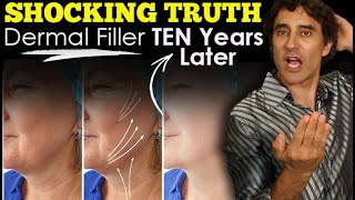 HOW LONG DOES DERMAL FILLER REALLY LAST  Dr Rajani [upl. by Jepum25]