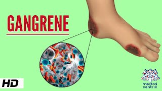 Gangrene Causes Signs and Symptoms Diagnosis and Treatment [upl. by Nylinnej]