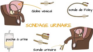 Comprendre le SONDAGE URINAIRE [upl. by Neraa]