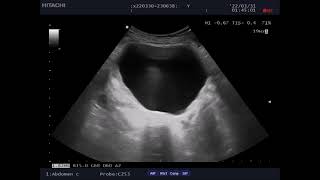 Case 242 Questions Young woman with Hypogastric pain and Constipation [upl. by Froemming869]