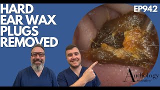 HARD EAR WAX PLUGS REMOVED  EP942 [upl. by Ailelc]