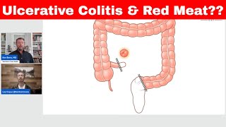 Ulcerative Colitis amp Red Meat Warning KENTCARNIVORE [upl. by Hermosa817]