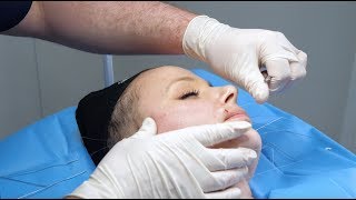 Silhouette Soft ThreadLift  Live Procedure at The Laser and Skin Clinic [upl. by Oisor507]