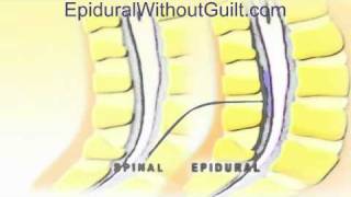 Animation of Difference Between Epidural and Spinal Techniques [upl. by Dnalyaw]