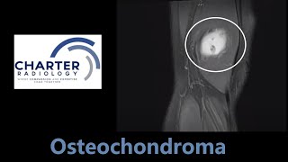 Osteochondroma  MRI Scan [upl. by Nitsirc]