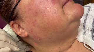 Removing Solar Lentignos amp Seborrheic Keratosis SKs with Lasers [upl. by Eiddam529]