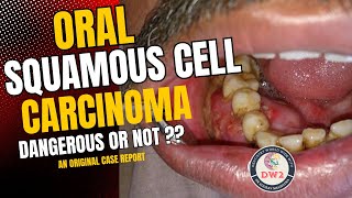 ORAL SQUAMOUS CELL CARCINOMA  HOW DANGEROUS OR LEATHAL IS IT  AN ORIGINAL CASE REPORT PART 1 [upl. by Auohp734]