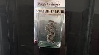 Ischemic Entritis case of ischemia of intestine likesharesubscribe MedicoMishtii [upl. by Nolham]