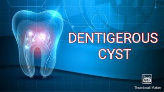 DENTIGEROUS CYST [upl. by Lamont]