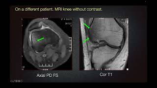 Sports Medicine Case 26 19yearold Soccer Player with Quadriceps Weakness [upl. by Frangos]