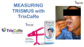 Measuring and Grading Trismus with TrisCaRe Dr Pawan Gupta ICanCaRe [upl. by Jacquet]