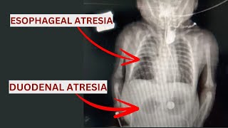 Esophageal Atresia amp Duodenal Atresia Qida borusu və Onikibarmaq bağırsaq Atreziyası [upl. by Sula]