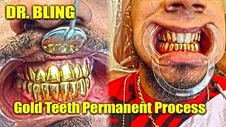 Gold Teeth Permanent Process  DR Bling [upl. by Enirbas]