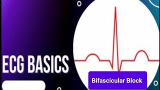 ECG Basics  Bifascicular Block  Electrophysiology and ECG criteria Bifascicular Block [upl. by Yelnahs]