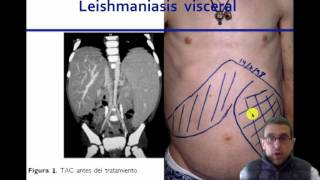 Esplenomegalia Un enfoque fisiopatologico umh 1931 [upl. by Eissirk]