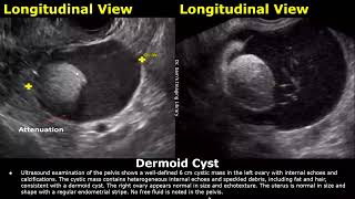 Ovary Ultrasound Reporting  Ovarian Diseases Scan Reports  How To Write USG Report  Pelvic USG [upl. by Larue643]