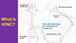What is HFNC [upl. by Zaraf]
