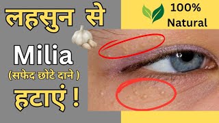 Milia Removal  आँखों के नीचे सफेद दाने हटाने का असान उपाय  Natural Home Remedy [upl. by Nacnud349]