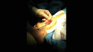 Achilles Tendon Rupture Repair Surgery  Houston Foot Surgeon [upl. by Aihppa105]