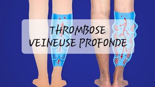 TVP  thrombose veineuse profonde [upl. by Chee517]