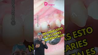 Que no te pase esto cariesdentales caries dentista limpiezadental dolordental [upl. by Goodill]