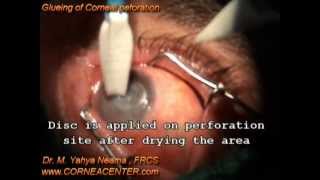 glueing corneal perforation [upl. by Okime]