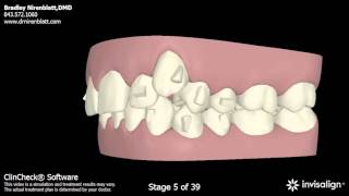 Invisalign Patients Before and After Nirenblatt Orthodontics [upl. by Led]