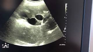 Dilated intrahepatic biliary radicles lab report is uploades in other video [upl. by Farro463]