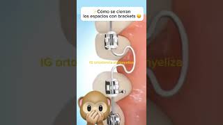 T loop orthodontics ортодонтия kieferorthopädie विषमदंत ortodonzia orthodontie orthodontie [upl. by Zedecrem]