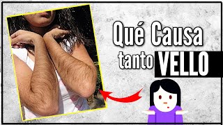 Vello en la Mujer ¿Por qué Crece Tanto  Hirsutismo y Exceso de Pelo en el Cuerpo [upl. by Adelina151]