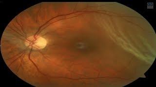 Retinal Detachment or Not [upl. by Zarihs]