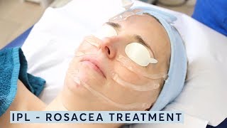 How to treat rosacea  IPL [upl. by Mulderig317]